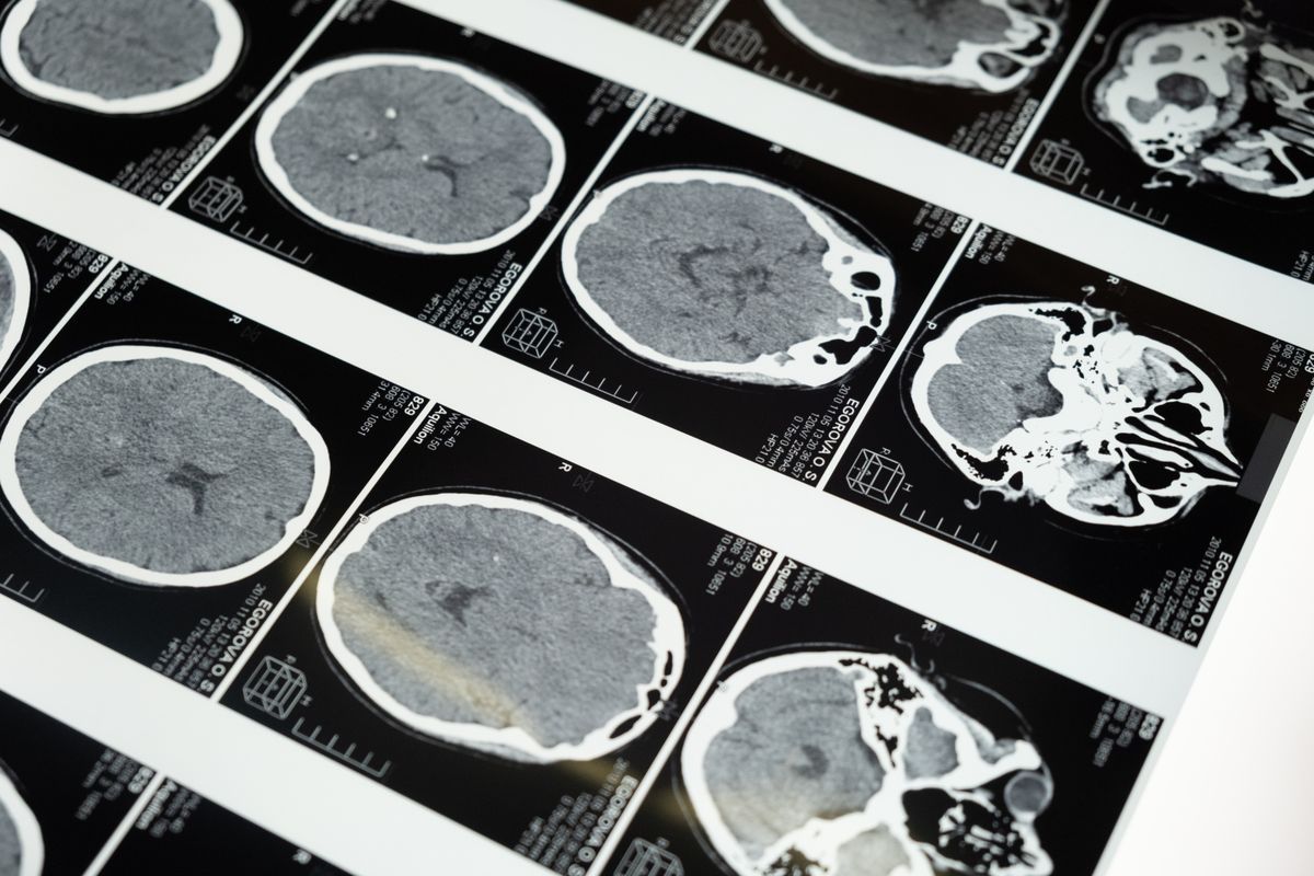Neuropsicología en Gabinet Psicològic Mataró